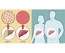 脂肪肝螞蟻莊園 吃素的人得脂肪肝是什么原因