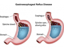 有些人吃完東西會覺得燒心可能是哪里出了問題